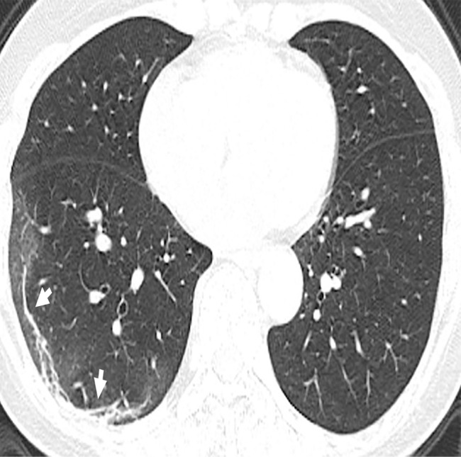 (a) Chest radiograph in a patient with COVID-19 infection demonstrates right infrahilar airspace opacities. (b) Axial and (c) sagittal chest CT images demonstrate peripheral right lower lobe ground-glass opacities. Follow-up (d) axial and (e) sagittal chest CT images 2 days later show improvement in the extent of ground-glass opacities, with more subpleural curvilinear lines (arrows).