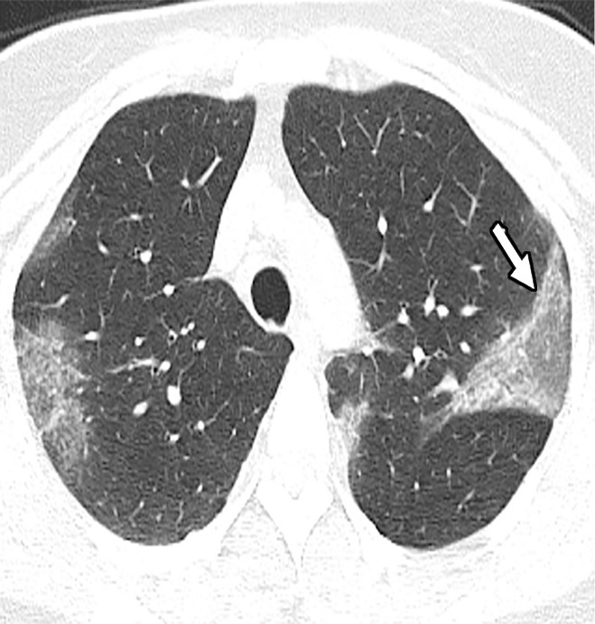 (a) Note the peripheral predominant airspace opacities with a reversed halo pattern in the left upper lobe (arrow). (b, c) Organizing changes with increasing attenuation are noted on follow-up CT images.