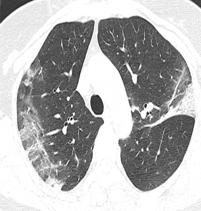 (a) Note the peripheral predominant airspace opacities with a reversed halo pattern in the left upper lobe (arrow). (b, c) Organizing changes with increasing attenuation are noted on follow-up CT images.