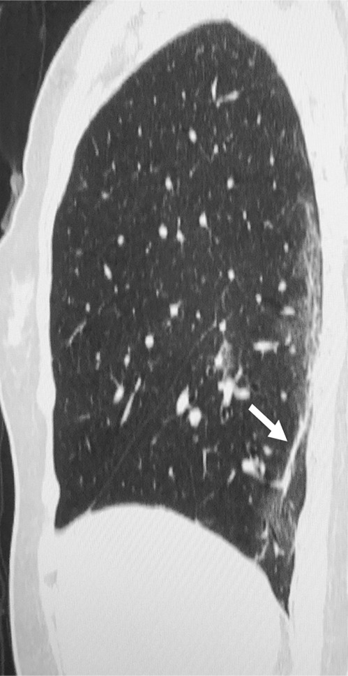 (a) Chest radiograph in a patient with COVID-19 infection demonstrates right infrahilar airspace opacities. (b) Axial and (c) sagittal chest CT images demonstrate peripheral right lower lobe ground-glass opacities. Follow-up (d) axial and (e) sagittal chest CT images 2 days later show improvement in the extent of ground-glass opacities, with more subpleural curvilinear lines (arrows).