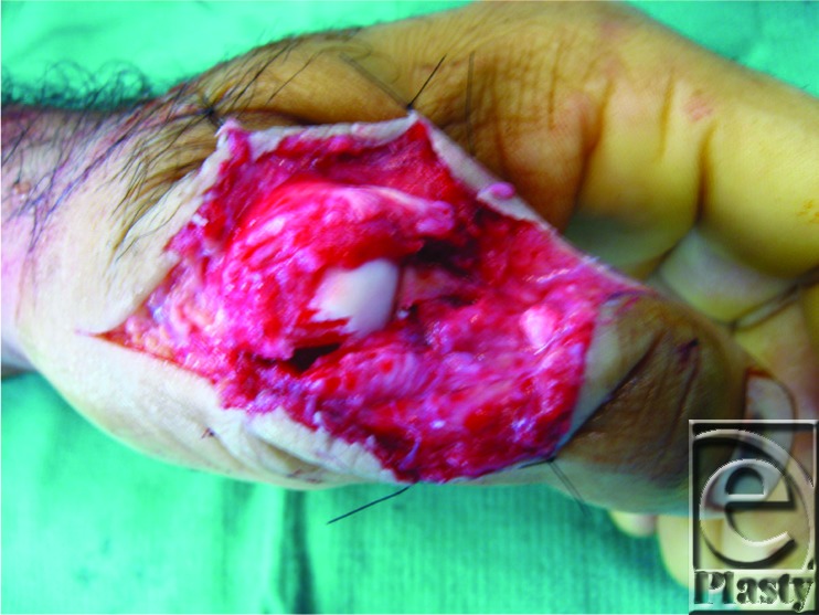 graphic file with name eplasty13ic02_fig2.jpg
