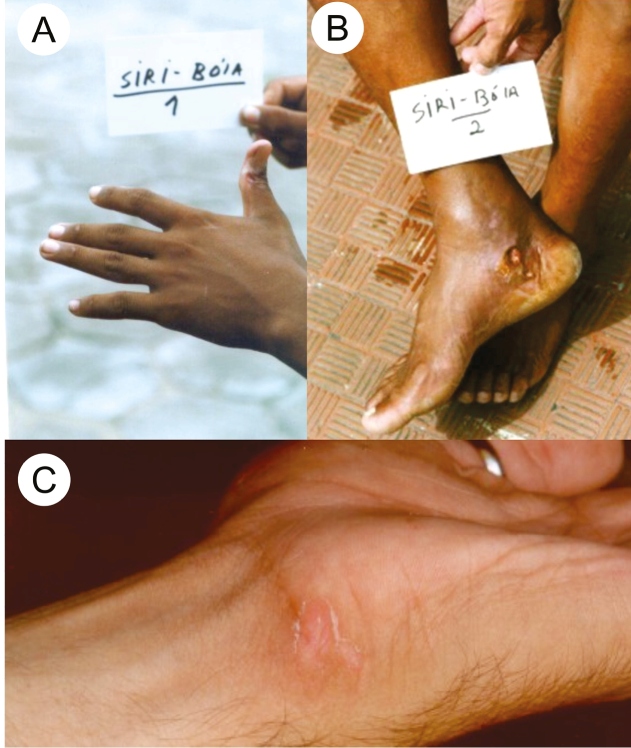 Injuries in humans caused by mantis shrimp or siriboia (Crustacea ...