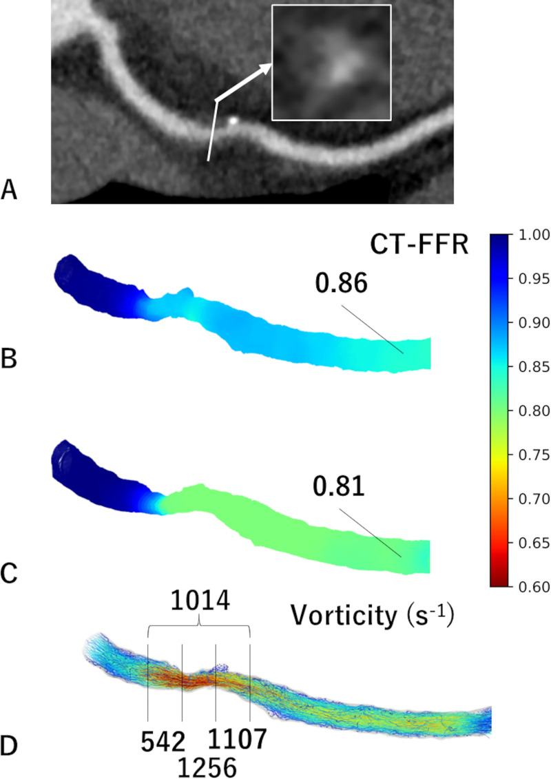 Images in a 55-year-old male participant with functional plaque progression at 2 years. (A) Coronary CT angiographic image with cross-sectional magnification (arrow) shows positive remodeling, low attenuation, and the napkin-ring sign. (B) The initial CT fractional flow reserve (CT-FFR) was 0.86, which progressed to (C) 0.81 in 2 years. (D) The vorticity of the distal segment of stenosis was 1107 sec-1 using the initial coronary CT data.