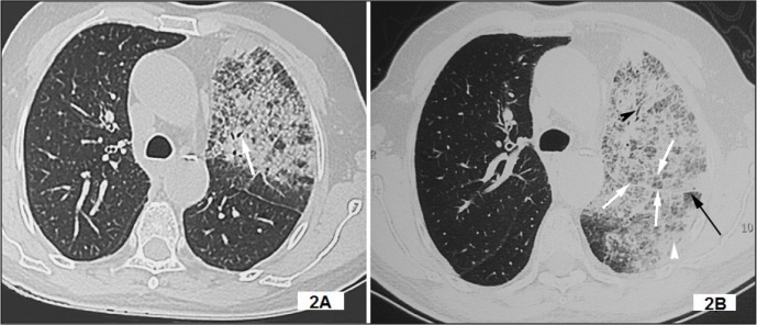 Image Diagnosis Bronchioloalveolar Carcinoma Presenting As Unilateral image-diagnosis-bronchioloalveolar-carcinoma-presenting-as-unilateral