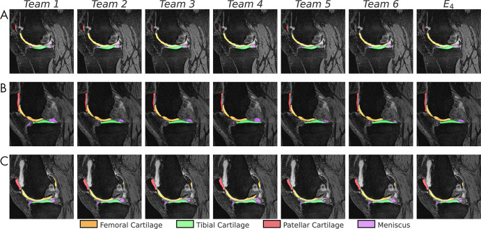 Sample segmentations (1.25× center zoom) of the lateral condyle in patients with Kellgren-Lawrence osteoarthritis grade 2 to 4 (A–C, respectively). The following tissues were segmented and colored: femoral cartilage (orange), tibial cartilage (green), patellar cartilage (red), and meniscus (purple). Segmentation differences appeared negligible among all networks, including the majority-vote ensemble (E4).