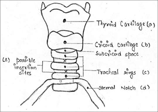 Percutaneous Tracheostomy - PMC