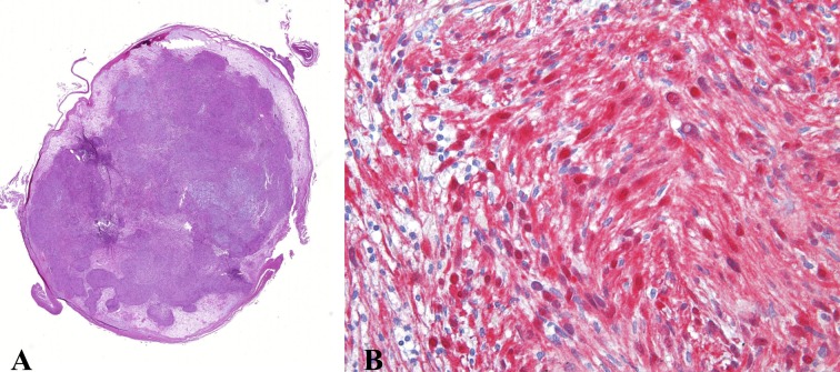 Schwannoma of the foot: report of four cases and literature review - PMC