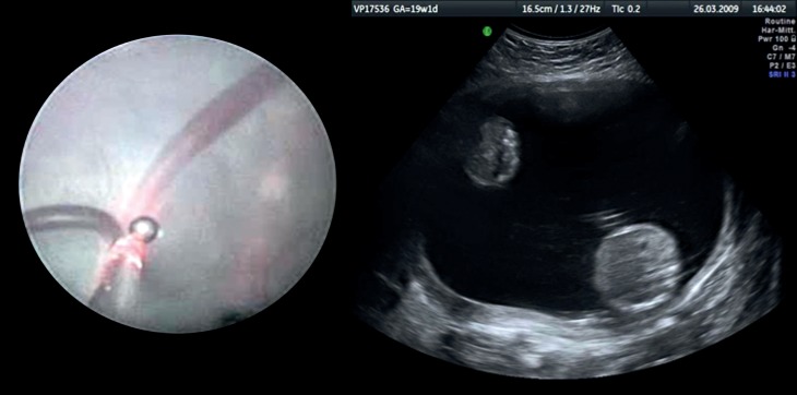 Figure 2: Twin-to-twin transfusion syndrome