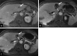Images show a 1.3-cm metastatic colorectal cancer in segment III of
the liver. (A) Preprocedure contrast-enhanced MRI scan shows tumor (arrow).
(B) Contrast-enhanced MRI scan obtained fewer than 36 hours postprocedure
with treatment zone (solid arrow) encompassing the site of the tumor and a
margin. Patent blood vessel (dashed arrow) traverses the treatment zone. (C)
Contrast-enhanced MRI scan obtained at 30 days postprocedure shows
involution of the treatment zone (solid arrow) with maintained patent vessel
(dashed arrow).