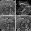 Images in a participant with a 2.3-cm hepatocellular carcinoma in
segment III of the liver. (A) Preprocedure contrast-enhanced MRI scan in the
late arterial phase shows hyperenhancing hepatocellular carcinoma (arrow).
(B) Intraprocedural US image shows defined treatment volume; the orange
circle outlines the hyperechoic targeted tumor and the red circle outlines
the planned margin. The treatment effect is visible as an echogenic bubble
cloud at the red crosshair, the focal point of the transducer. The robotic
arm moves the focal point through the planned treatment volume to create the
volumetric treatment. (C) Contrast-enhanced MRI scan obtained less than 36
hours postprocedure in the late arterial phase shows the nonenhancing
treatment zone (black arrow). Note patent blood vessels (dashed white
arrows). (D) Contrast-enhanced MRI scan obtained 30 days postprocedure in
the late arterial phase shows partial involution of the treatment zone
(arrow).