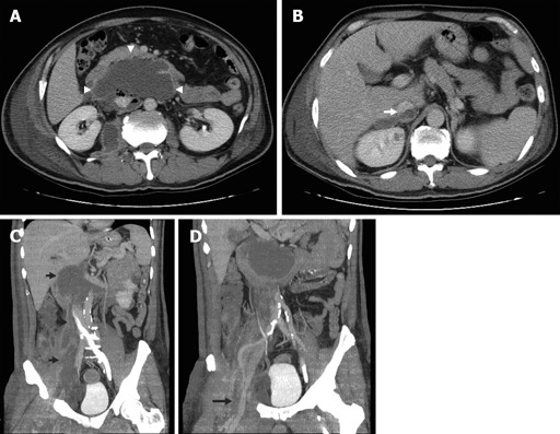 Extensive retroperitoneal and right thigh abscess in a patient with ...