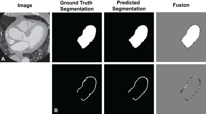 Example of segmentation error metrics. (A) An axial section of the heart and the corresponding ground truth and predicted segmentation from one of the patients; model combinations are shown. The Dice coefficient was used to assess overall segmentation accuracy and is illustrated by the fused image (right), with agreement shown in white and disagreement in black (in this section, the left ventricular [LV] Dice coefficient = 0.910). (B) Segmentation errors due to the compressed image representations are expected to occur primarily at the boundary. Therefore, we isolated the boundary of each segmentation and calculated a border Dice score (in this section, the LV border Dice coefficient = 0.402).