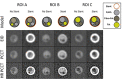 Coronary phantom content and imaging. Each column shows a different region
of interest (ROI), with the detailed 5-mm probe content shown in the top row.
Cross-sections of the probe at energy-integrating detector CT (EID; second row),
photon-counting CT (PCCT; third row), and high-resolution PCCT (HR PCCT; fourth
row) with and without stents. Window and level for unstented cases was 1600 HU
and 300 HU and for stented cases was 1000 HU and 250 HU, respectively.
(Reprinted, with permission, from reference 15.)