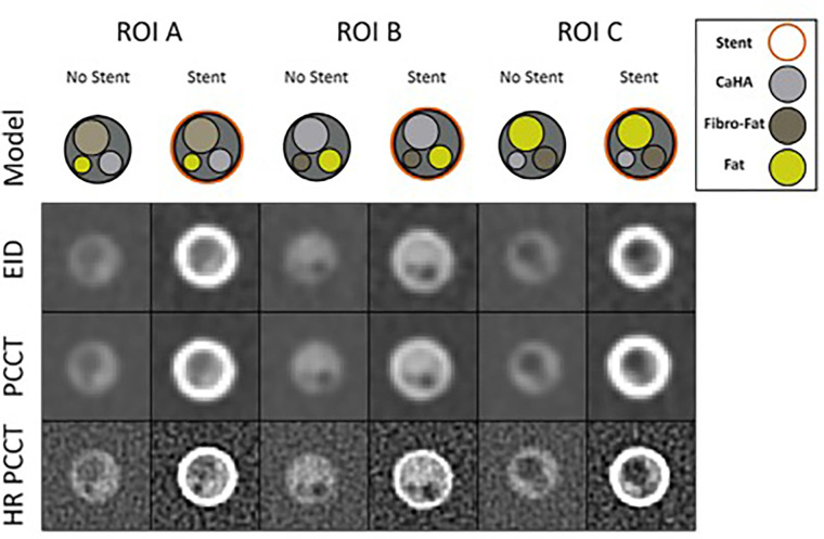 Coronary phantom content and imaging. Each column shows a different region of interest (ROI), with the detailed 5-mm probe content shown in the top row. Cross-sections of the probe at energy-integrating detector CT (EID; second row), photon-counting CT (PCCT; third row), and high-resolution PCCT (HR PCCT; fourth row) with and without stents. Window and level for unstented cases was 1600 HU and 300 HU and for stented cases was 1000 HU and 250 HU, respectively. (Reprinted, with permission, from reference 15.)