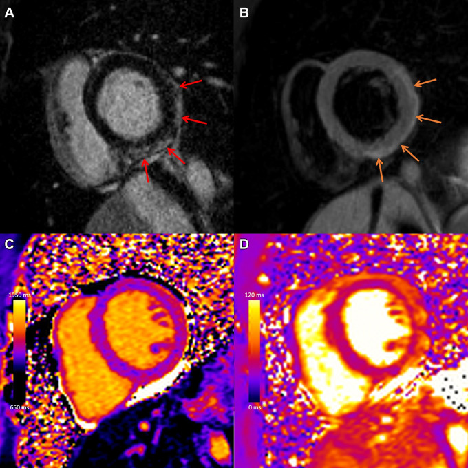 COVID-19 vaccine–associated myocarditis. Case example in a 27-year-old man with myocarditis 3 days following COVID-19 vaccine administration. Images from cardiac MRI performed at 1.5 T demonstrate subepicardial late gadolinium enhancement at the (A) basal to mid anterior lateral, inferior lateral, and inferior wall (red arrows), with (B) corresponding high T2 signal (orange arrows), (C) high regional native T1 (1173 msec), and (D) high regional native T2 (59 msec) on short-axis images. (Reprinted, with permission, from reference 29.)