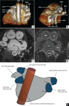 Position of the descending aorta relative to the left atrium (LA). (A)
Multiplanar reconstruction displaying a posterior view of the LA and the
descending aorta (AOD). (B) Multiplanar reconstruction displaying an axial view
of the LA and the AOD. (C) Contrast-enhanced MR angiogram of the LA and aorta.
(D) Late gadolinium enhancement MRI of the LA and the aorta. (E) An illustration
of the LA incorporating a common location of the AOD. AOA = ascending aorta, LAA
= LA appendage, LIPV = left inferior PV, LSPV = left superior PV, PA = pulmonary
artery, PV = pulmonary vein, RIPV = right inferior PV, RSPV = right superior PV.
(Reprinted, with permission, from reference 23.)