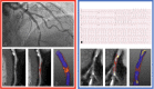 Representative images of CT plaque analysis demonstrate differences
between type 1 and type 2 myocardial infarction. Left panel: Images in a
42-year-old man diagnosed with type 1 myocardial infarction. (A) Invasive
angiography demonstrates severe stenosis in the distal left anterior descending
artery. (B) Coronary CT angiogram, curved planar reformation, (C) quantitative
plaque analysis, and (D) three-dimensional quantitative plaque analysis
demonstrate a high burden of low-attenuation plaque. Right panel: Images in a
74-year-old man diagnosed with type 2 myocardial infarction. (E)
Electrocardiogram demonstrates broad-complex tachycardia consistent with
ventricular tachycardia. (F) Coronary CT angiogram, curved planar reformation,
(G) quantitative plaque analysis, and (H) three-dimensional quantitative plaque
analysis demonstrate a low burden of low-attenuation plaque. Both participants
have obstructive coronary artery disease detected with coronary CT angiography.
Quantitative plaque analysis demonstrates clear differences, with a much higher
burden of low-attenuation plaque in the participant presenting with type 1
myocardial infarction compared with the participant presenting with type 2.
(Reprinted, with permission, from reference 5.)