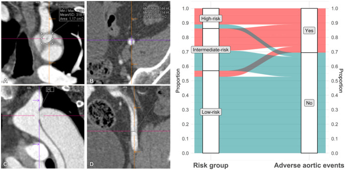 On the left: Multiplanar reconstructions of a CT angiographic study show (A, C) the proximal entry tear in the aortic isthmus and (B, D) the distal entry tear in the left external iliac artery in a 49-year-old man with an uncomplicated type B aortic dissection 3 months after discharge. Entry tears are measured in a double oblique en face view close to the (A) coronal plane in a 1.2-cm2 proximal tear and (B) in the axial plane in a 0.5-cm2 distal tear. (C) A sagittal plane of the arch and descending thoracic aorta and (D) a coronal plane of the left iliac artery are provided as references for tear location and plane adjustment. Crosshairs indicate the exact location of each tear in two planes. On the right: Distribution and rate of adverse events in study participants according to risk group. Only three of 41 participants in the low-risk group (7%), which comprised 57% of the total cohort (41 of 72), had a nonacute long-term aortic event (elective surgery). Max = maximum, Min = minimum. (Adapted, with permission, from reference 36.)