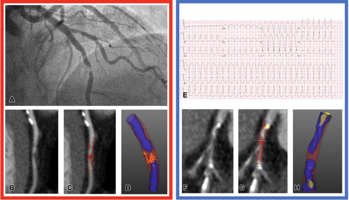 Representative images of CT plaque analysis demonstrate differences between type 1 and type 2 myocardial infarction. Left panel: Images in a 42-year-old man diagnosed with type 1 myocardial infarction. (A) Invasive angiography demonstrates severe stenosis in the distal left anterior descending artery. (B) Coronary CT angiogram, curved planar reformation, (C) quantitative plaque analysis, and (D) three-dimensional quantitative plaque analysis demonstrate a high burden of low-attenuation plaque. Right panel: Images in a 74-year-old man diagnosed with type 2 myocardial infarction. (E) Electrocardiogram demonstrates broad-complex tachycardia consistent with ventricular tachycardia. (F) Coronary CT angiogram, curved planar reformation, (G) quantitative plaque analysis, and (H) three-dimensional quantitative plaque analysis demonstrate a low burden of low-attenuation plaque. Both participants have obstructive coronary artery disease detected with coronary CT angiography. Quantitative plaque analysis demonstrates clear differences, with a much higher burden of low-attenuation plaque in the participant presenting with type 1 myocardial infarction compared with the participant presenting with type 2. (Reprinted, with permission, from reference 5.)