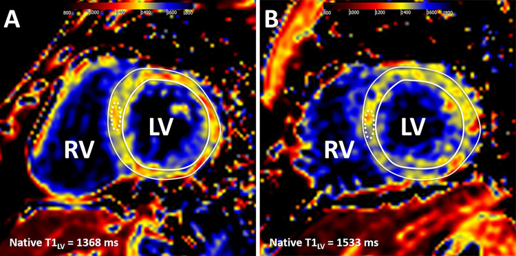 Cardiac MR native T1 mapping images in adults born (A) term and (B) preterm. Native T1 values were measured in a midventricular section, with global left ventricular (LV) values recorded as a mean native T1 value for the entire mid-LV section (T1LV) and as a mean T1 value for a 1-cm2 region of interest in the septum (dotted line). RV = right ventricle. (Reprinted, with permission, from reference 22.)