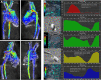 Four-dimensional (4D) flow assessment in an 11-year-old patient with
hypoplastic left heart syndrome after intra-atrial lateral tunnel Fontan
procedure. (A) Streamline visualization with velocity color coding of 4D flow
data. (B) Flow quantification in the aorta (Ao) (red), superior vena cava (SVC)
and lateral tunnel (LT) (green), left pulmonary artery (LPA) (yellow), and right
pulmonary veins (RPVs) (blue). IVC = inferior vena cava, SV = single ventricle.
(Reprinted, with permission, from reference 18.)
