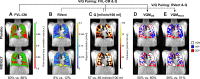 PREFUL MRI parameter maps following treatment with placebo and IND-GLY in
one patient. Shown are the FVL-CM (see Figs 1 and 2 in reference 42), RVent, Q,
VQMCM, and VQMRVent of one patient with COPD (man, 67 years old,
postbronchodilator FEV1 at baseline of 31.6% and FEV1 postbronchodilator
treatment of 36.7%, GOLD stage 3) for one coronal section located at the
tracheal bifurcation. Note the difference between postplacebo and
postbronchodilator treatment: (A) 80% versus 86% (FVL-CM), (B) 8% versus 12%
(RVent), (C) 57 versus 85 mL/min/100 mL (Q), (D) 50% versus 60% (VQMCM), and (E)
36% versus 51% (VQMRVent), respectively. Ventilation and perfusion defects (VDP
and QDP) were defined as values below threshold (Q < 20 mL/min/100 mL,
FVL-CM < 0.9, RVent < 0.075). Images were acquired without
contrast agent administration using a two-dimensional gradient-echo sequence in
coronal orientation. COPD = chronic obstructive pulmonary disease, FVL-CM =
flow-volume loop correlation map, GOLD = Global Initiative for Chronic
Obstructive Lung Disease, IND/GLY = indacaterol-glycopyrronium, PREFUL =
phase-resolved functional lung, Q = perfusion, QDP = perfusion defect
percentage, RVent = regional ventilation, V = ventilation, VDP = ventilation
defect percentage, V/Q = ventilation-perfusion, VQM = ventilation-perfusion
match, VQMCM = ventilation-perfusion match with Q and FVL-CM, VQMRVent =
ventilation-perfusion match with Q and RVent. (Adapted, with permission, from
reference 42.)