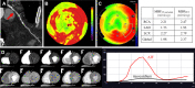 Images in a 72-year-old man with diabetes and hyperlipidemia. (A) Coronary
CT angiographic image shows severe stenosis (red arrow) in the proximal portion
of the left anterior descending artery (LAD). Both the (B) MBF CT map and (C)
MBF PET map demonstrate similar distribution of abnormal perfusion in the
anteroseptal wall and apex corresponding to the LAD stenosis. (D) The dynamic CT
perfusion (CTP) images and time-attenuation curve obtained with dynamic CTP are
demonstrated. AIF = arterial input function, LCX = left circumflex artery, MBF =
myocardial blood flow, MBFCT = CT-derived MBF, MBFCT-corrected = CT-derived MBF
after correction with the fitting curve, MBFPET = PET-derived MBF, RCA = right
coronary artery. (Reprinted, with permission, from reference 12.)