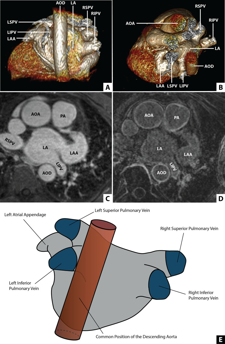 Position of the descending aorta relative to the left atrium (LA). (A) Multiplanar reconstruction displaying a posterior view of the LA and the descending aorta (AOD). (B) Multiplanar reconstruction displaying an axial view of the LA and the AOD. (C) Contrast-enhanced MR angiogram of the LA and aorta. (D) Late gadolinium enhancement MRI of the LA and the aorta. (E) An illustration of the LA incorporating a common location of the AOD. AOA = ascending aorta, LAA = LA appendage, LIPV = left inferior PV, LSPV = left superior PV, PA = pulmonary artery, PV = pulmonary vein, RIPV = right inferior PV, RSPV = right superior PV. (Reprinted, with permission, from reference 23.)