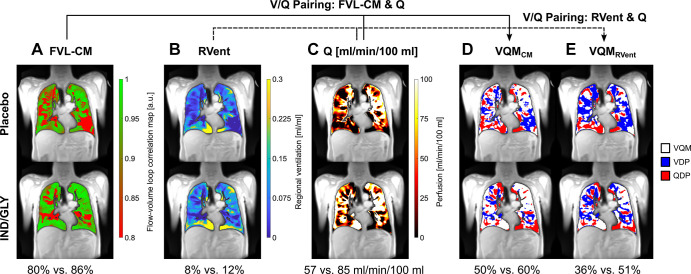 PREFUL MRI parameter maps following treatment with placebo and IND-GLY in one patient. Shown are the FVL-CM (see Figs 1 and 2 in reference 42), RVent, Q, VQMCM, and VQMRVent of one patient with COPD (man, 67 years old, postbronchodilator FEV1 at baseline of 31.6% and FEV1 postbronchodilator treatment of 36.7%, GOLD stage 3) for one coronal section located at the tracheal bifurcation. Note the difference between postplacebo and postbronchodilator treatment: (A) 80% versus 86% (FVL-CM), (B) 8% versus 12% (RVent), (C) 57 versus 85 mL/min/100 mL (Q), (D) 50% versus 60% (VQMCM), and (E) 36% versus 51% (VQMRVent), respectively. Ventilation and perfusion defects (VDP and QDP) were defined as values below threshold (Q < 20 mL/min/100 mL, FVL-CM < 0.9, RVent < 0.075). Images were acquired without contrast agent administration using a two-dimensional gradient-echo sequence in coronal orientation. COPD = chronic obstructive pulmonary disease, FVL-CM = flow-volume loop correlation map, GOLD = Global Initiative for Chronic Obstructive Lung Disease, IND/GLY = indacaterol-glycopyrronium, PREFUL = phase-resolved functional lung, Q = perfusion, QDP = perfusion defect percentage, RVent = regional ventilation, V = ventilation, VDP = ventilation defect percentage, V/Q = ventilation-perfusion, VQM = ventilation-perfusion match, VQMCM = ventilation-perfusion match with Q and FVL-CM, VQMRVent = ventilation-perfusion match with Q and RVent. (Adapted, with permission, from reference 42.)