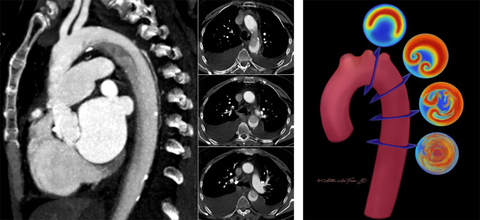 On the left: The “Dean effect” artifact in a 71-year-old woman with increasing dyspnea and a history of hypertension, atrial fibrillation, mitral regurgitation, and congestive heart failure (New York Heart Association grade IV) with an estimated ejection fraction of 20%. One sagittal (left) maximum intensity projection and three axial (right; 3.0-mm section thickness) contrast-enhanced (Omnipaque 350; GE Healthcare) CT angiographic images of the thorax through the level of the aortic arch in a narrowed and decentered soft-tissue window (convolutional kernel l40) demonstrate a flow-related artifact with distinct flow separation. This results in a heterogeneous hypoattenuation along the inner curvature of the arch due to incomplete mixing of unopacified blood with contrast material. The sagittal plane best demonstrates that the finding is artifactual. On the right: Artist’s conceptual illustration of the proposed process of flow perturbation and mixing of blood as it flows from the proximal aorta (superiormost cross section) to the descending aorta (inferiormost cross section). The highest-velocity flow (red) occurs at the outer curvature, while the lowest-velocity flow (blue) occurs at the inner curvature. This unique separation of differential flow velocities is the hypothesized origin of the artifact. As the Dean vortices form (second cross section) and begin to experience flow perturbation and mixing (third cross section), there is eventual flow velocity homogenization and a return to more normal laminar flow as the blood enters the straight tube of the descending aorta (fourth cross section). (Illustration reprinted, with permission, from Aletta Ann Frazier MD.) (Figures adapted, with permission, from reference 38.)