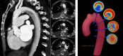 On the left: The “Dean effect” artifact in a 71-year-old
woman with increasing dyspnea and a history of hypertension, atrial
fibrillation, mitral regurgitation, and congestive heart failure (New York Heart
Association grade IV) with an estimated ejection fraction of 20%. One sagittal
(left) maximum intensity projection and three axial (right; 3.0-mm section
thickness) contrast-enhanced (Omnipaque 350; GE Healthcare) CT angiographic
images of the thorax through the level of the aortic arch in a narrowed and
decentered soft-tissue window (convolutional kernel l40) demonstrate a
flow-related artifact with distinct flow separation. This results in a
heterogeneous hypoattenuation along the inner curvature of the arch due to
incomplete mixing of unopacified blood with contrast material. The sagittal
plane best demonstrates that the finding is artifactual. On the right:
Artist’s conceptual illustration of the proposed process of flow
perturbation and mixing of blood as it flows from the proximal aorta
(superiormost cross section) to the descending aorta (inferiormost cross
section). The highest-velocity flow (red) occurs at the outer curvature, while
the lowest-velocity flow (blue) occurs at the inner curvature. This unique
separation of differential flow velocities is the hypothesized origin of the
artifact. As the Dean vortices form (second cross section) and begin to
experience flow perturbation and mixing (third cross section), there is eventual
flow velocity homogenization and a return to more normal laminar flow as the
blood enters the straight tube of the descending aorta (fourth cross section).
(Illustration reprinted, with permission, from Aletta Ann Frazier MD.) (Figures
adapted, with permission, from reference 38.)