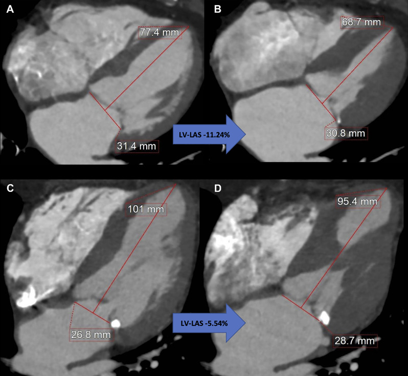 Measurement of coronary CT angiography–derived left ventricular (LV) long-axis shortening (LAS) using a reconstructed four-chamber view. Images at (A) end diastole and (B) end systole in an 87-year-old woman with LV-LAS of −11.24%, an ejection fraction of 75%, and a Society of Thoracic Surgeons Predicted Risk of Mortality (STS-PROM) of 6.0% who remained alive after undergoing transcatheter aortic valve replacement (TAVR) for severe aortic stenosis. Images at (C) end diastole and (D) end systole in an 88-year-old man with LV-LAS of −5.54%, an ejection fraction of 67%, and an STS-PROM of 3.6% who died 9 months after undergoing TAVR for severe aortic stenosis. (Reprinted, with permission, from reference 7.)