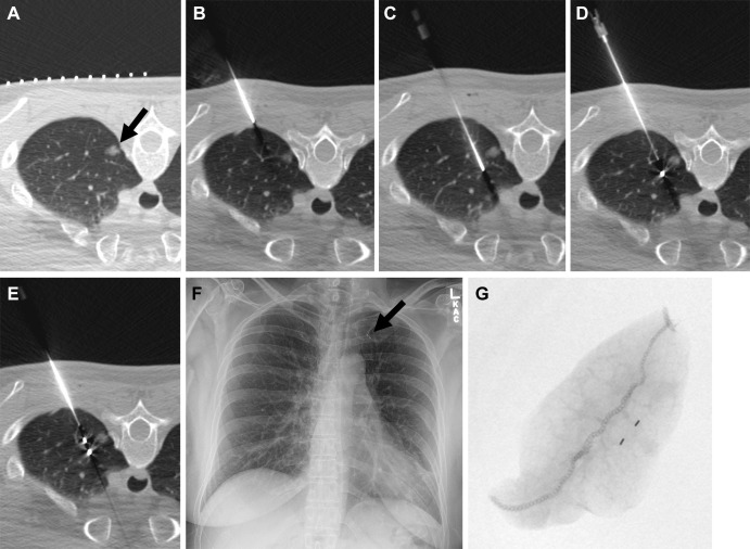 Images in a 50-year-old woman with an incidentally detected, enlarging, 10-mm, left upper lobe, part-solid nodule proven to be adenocarcinoma (100% lepidic). (A) Preliminary axial CT image shows a left upper lobe nodule (arrow). (B) The coaxial introducer needle was advanced through the subcutaneous tissue to the pleura. (C) The needle was advanced deeply to the nodule. (D) The first 3-mm gold fiducial marker was deployed, and the needle was retracted. (E) The second fiducial marker was deployed with the nodule sandwiched between fiducial markers and the pleura. (F) Postprocedure radiograph demonstrates the two fiducial markers in the left upper lung (arrow). (G) Radiograph of the specimen with two fiducial markers in the specimen. (Reprinted, with permission, from reference 41.)