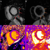 COVID-19 vaccine–associated myocarditis. Case example in a
27-year-old man with myocarditis 3 days following COVID-19 vaccine
administration. Images from cardiac MRI performed at 1.5 T demonstrate
subepicardial late gadolinium enhancement at the (A) basal to mid anterior
lateral, inferior lateral, and inferior wall (red arrows), with (B)
corresponding high T2 signal (orange arrows), (C) high regional native T1 (1173
msec), and (D) high regional native T2 (59 msec) on short-axis images.
(Reprinted, with permission, from reference 29.)