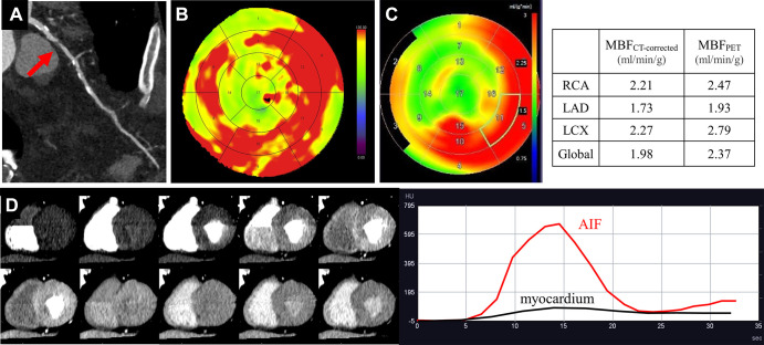 Images in a 72-year-old man with diabetes and hyperlipidemia. (A) Coronary CT angiographic image shows severe stenosis (red arrow) in the proximal portion of the left anterior descending artery (LAD). Both the (B) MBF CT map and (C) MBF PET map demonstrate similar distribution of abnormal perfusion in the anteroseptal wall and apex corresponding to the LAD stenosis. (D) The dynamic CT perfusion (CTP) images and time-attenuation curve obtained with dynamic CTP are demonstrated. AIF = arterial input function, LCX = left circumflex artery, MBF = myocardial blood flow, MBFCT = CT-derived MBF, MBFCT-corrected = CT-derived MBF after correction with the fitting curve, MBFPET = PET-derived MBF, RCA = right coronary artery. (Reprinted, with permission, from reference 12.)