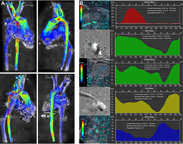 Four-dimensional (4D) flow assessment in an 11-year-old patient with hypoplastic left heart syndrome after intra-atrial lateral tunnel Fontan procedure. (A) Streamline visualization with velocity color coding of 4D flow data. (B) Flow quantification in the aorta (Ao) (red), superior vena cava (SVC) and lateral tunnel (LT) (green), left pulmonary artery (LPA) (yellow), and right pulmonary veins (RPVs) (blue). IVC = inferior vena cava, SV = single ventricle. (Reprinted, with permission, from reference 18.)