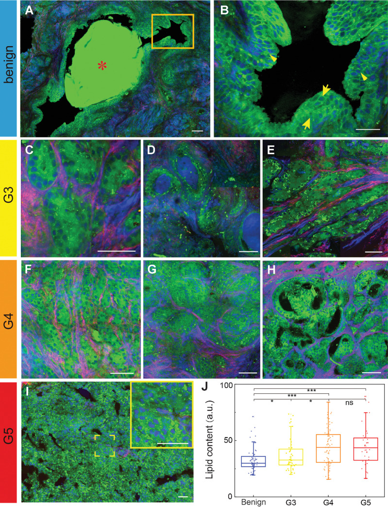 Figure 2. SRS reveals diagnostic features of fresh prostate tissues. Key histologic hallmarks of different Gleason patterns, including: amylacea (A) and the double-layered cellular structure of normal prostatic ducts of the benign group (B), zoomed image from the yellow rectangle in A; small glands (C), large glands (D) and branched ducts of G3 (E); fused pattern of cords or chains (F), the glomeruloid pattern (G), and the cribriform pattern of G4 (H); the central necrosis within papillary and cribriform spaces for G5 (I). J, Quantification of lipid contents in different patterns (*, P < 0.05, ***, P < 0.001; ns, not significant (P > 0.05) from two-tail unpaired t tests). Green: lipid; blue: protein; red: collagen. Scale bars, 50 μmol/L.