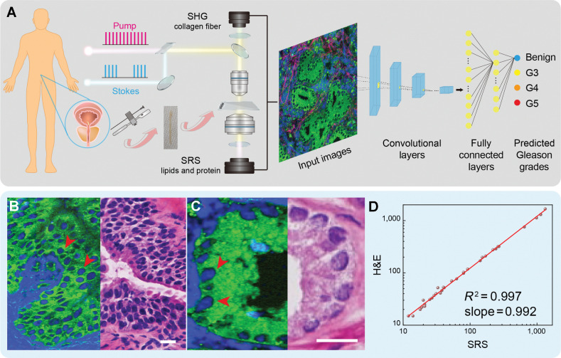 Figure 1. Experimental design and workflow. A, Illustration of prostate FT and taking fresh biopsy for SRS imaging and CNN-based Gleason grading and scoring. B, and C, SRS (left) and H&E (right) images of adjacent frozen sections from prostate tissues. D, Linear correlation plot of cell counting from SRS and H&E images (correlation factor R2 = 0.997). SRS images are color coded, green: lipid; blue: protein; red: collagen (SHG @ 405 nm). Scale bars, 25 μmol/L.