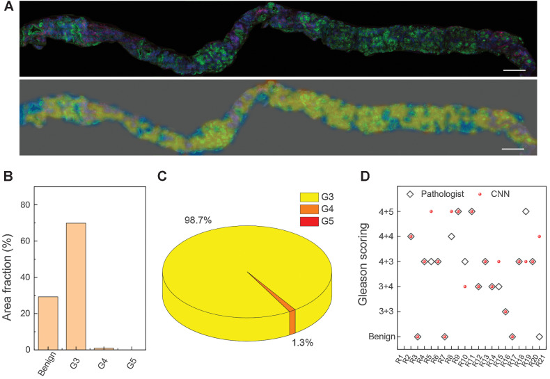 Figure 5. Color-coded and scoring fresh FT core needle biopsy. A, The presented SRS image of fresh FT core needle biopsy and the corresponding color-coded grading image. B, The quantification analysis of the area fraction of benign and G3–G5. C, The proportion of each Gleason pattern (G3–G5) in the whole tumor region. D, Diagnostic scoring results of CNN based SRS, compared with the consensus of three pathologists on 21 cases. Scale bars, 500 μmol/L.