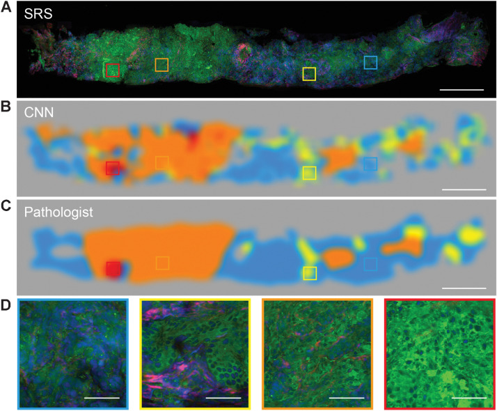 Figure 4. Visualizing the CNN feature representations. The typical SRS images of core needle biopsy (A) and corresponding activation heatmaps of benign and G3, G4, G5 patterns (B). C, The Gleason grading map merged from recoded color activation heatmaps (B). D, Zoom-in SRS images represented four class of benign and G3, G4, and G5 patterns. Scale bars, 500 μmol/L in A–C, 50 μmol/L in D.