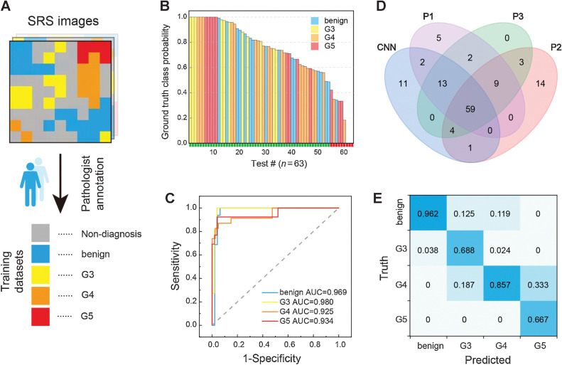 Figure 3. Automated diagnosis with deep learning on SRS images. A, Presegmentation and annotation of the whole-slide SRS images for training. Test results of the CNN model (B) and its ROC curves and AUC for the classification of benign and G3–G5 (C). D, Venn diagram of the diagnostic results of CNN model and three pathologists. E, Confusion matrix of the four diagnostic subtypes between CNN and the consensus of three pathologists.