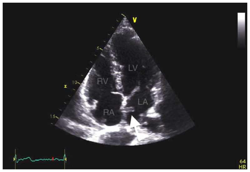 Patent Foramen Ovale Closure With the Gore Septal Occluder: Initial UK ...