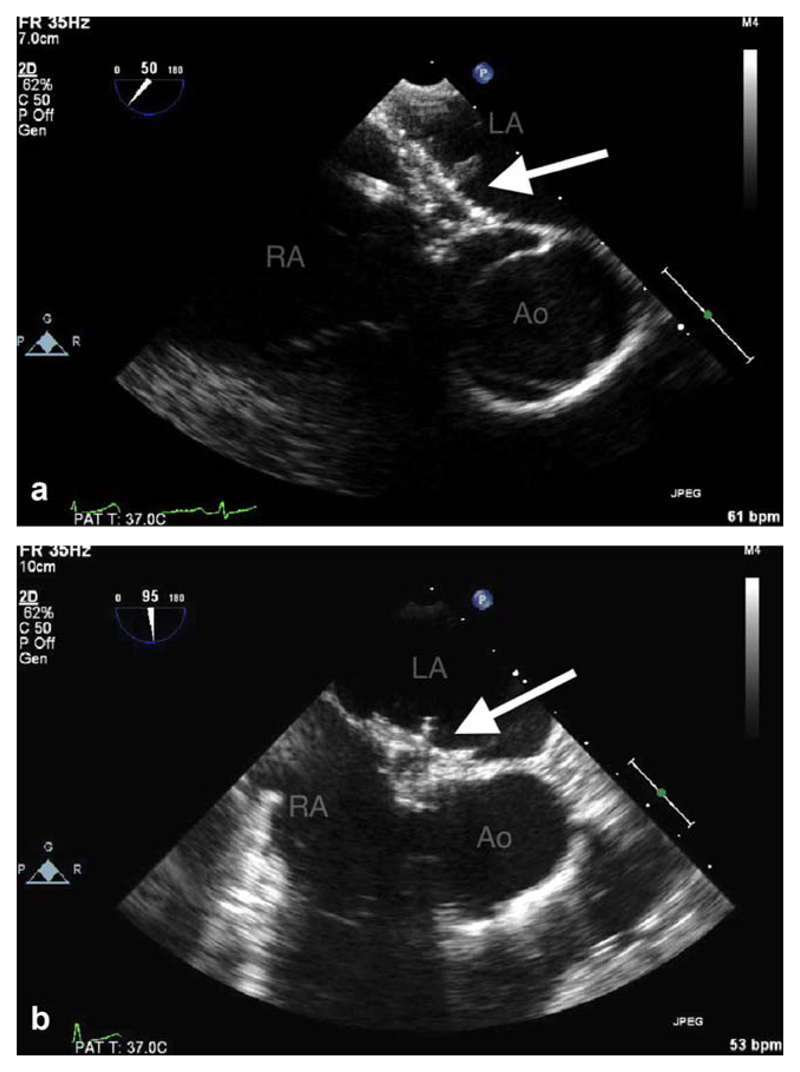 Patent Foramen Ovale Closure With the Gore Septal Occluder: Initial UK ...