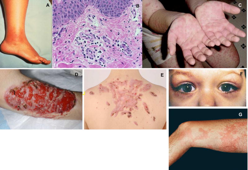 Dermatologic Manifestations Of Monogenic Autoinflammatory Diseases Pmc