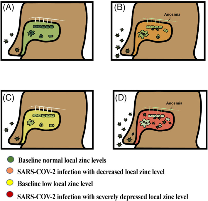 Intra‐nasal zinc level relationship to COVID‐19 anosmia and type 1 ...