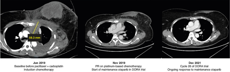 Figure 2. Case study: maintenance olaparib in wild-type germline BRCA metastatic triple-negative breast cancer. PR, partial response.