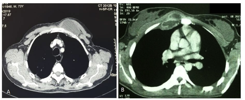 Tuberculous cold abscess of the chest wall: A clinical and surgical ...