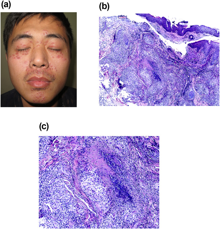 A case of lupus miliaris disseminatus faciei pmc