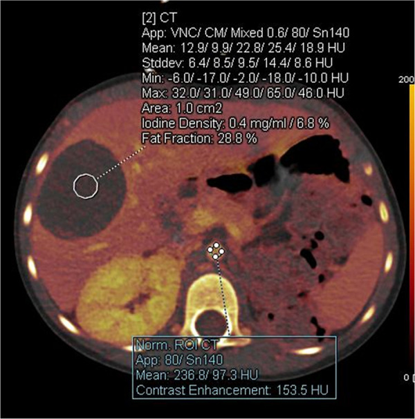 Incidentally detected hepatic lesion in a 3-year-old girl who had undergone a left nephrectomy for Wilms tumor. Axial iodine-enhanced CT image shows a hepatic mass with minimal iodine content (0.4 mg/mL). Circles are ROIs placed on liver and aorta. MRI confirmed a hepatic cyst. App = application, CM = contrast material, ROI = region of interest, Stddev = standard deviation, VNC = virtual noncontrast.