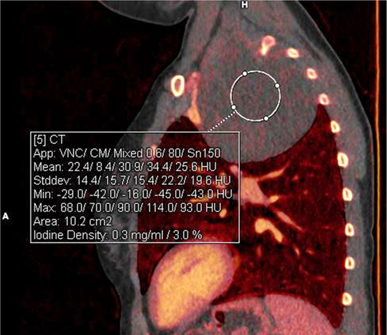 Benign mediastinal mass in a 16-year-old boy. (a) Coronal 40-keV CT image shows a posterior mediastinal mass. (b) Sagittal iodine-specific CT image shows trace iodine content, measured at 0.3 mg/mL. Circle indicates the region of interest. Note the iodine content in the mass is similar to that of muscle. Ganglioneuroma confirmed on surgical resection. App = application, CM = contrast material, Stddev = standard deviation, VNC = virtual noncontrast.